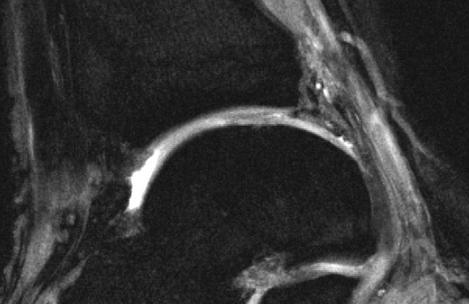 Imaging of Cartilage Repair dgemric