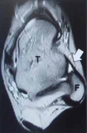 Preoperative Anterior talofibular