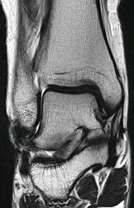 Lateral Ankle Ligament