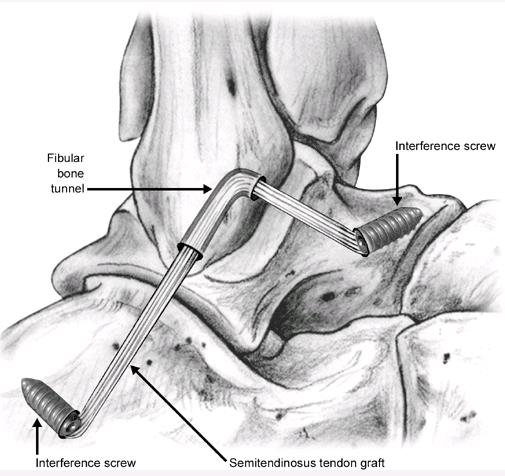 2007 - calcaneofibular ligament (CFL) Penner M.