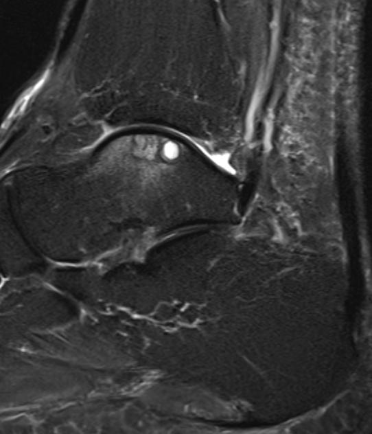 Imaging of Cartilage Repair Postoperative cartilage assessment : 1. Defect filling 2. Integration to border zone 3.