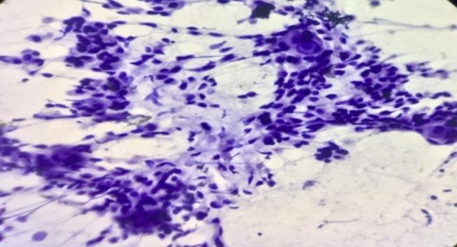 Todase V et al. Int J Res Med Sci. 2017 Jun;5(6):2406-2411 Figure 3: FNAC image of mucoepidermoid carcinoma (H and E stained 10x view). of 0.73:1.