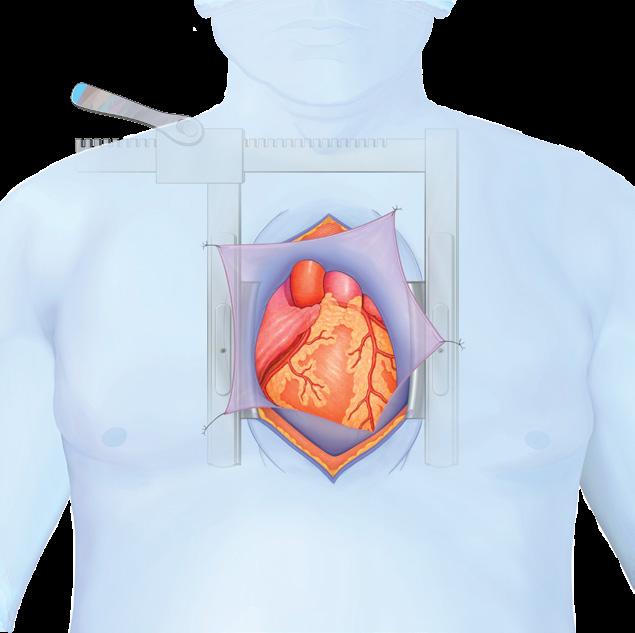 Procedural Overview of a Typical Open-heart Surgery 1. You will be administered general anesthesia to remain asleep and pain free during the procedure. 2.