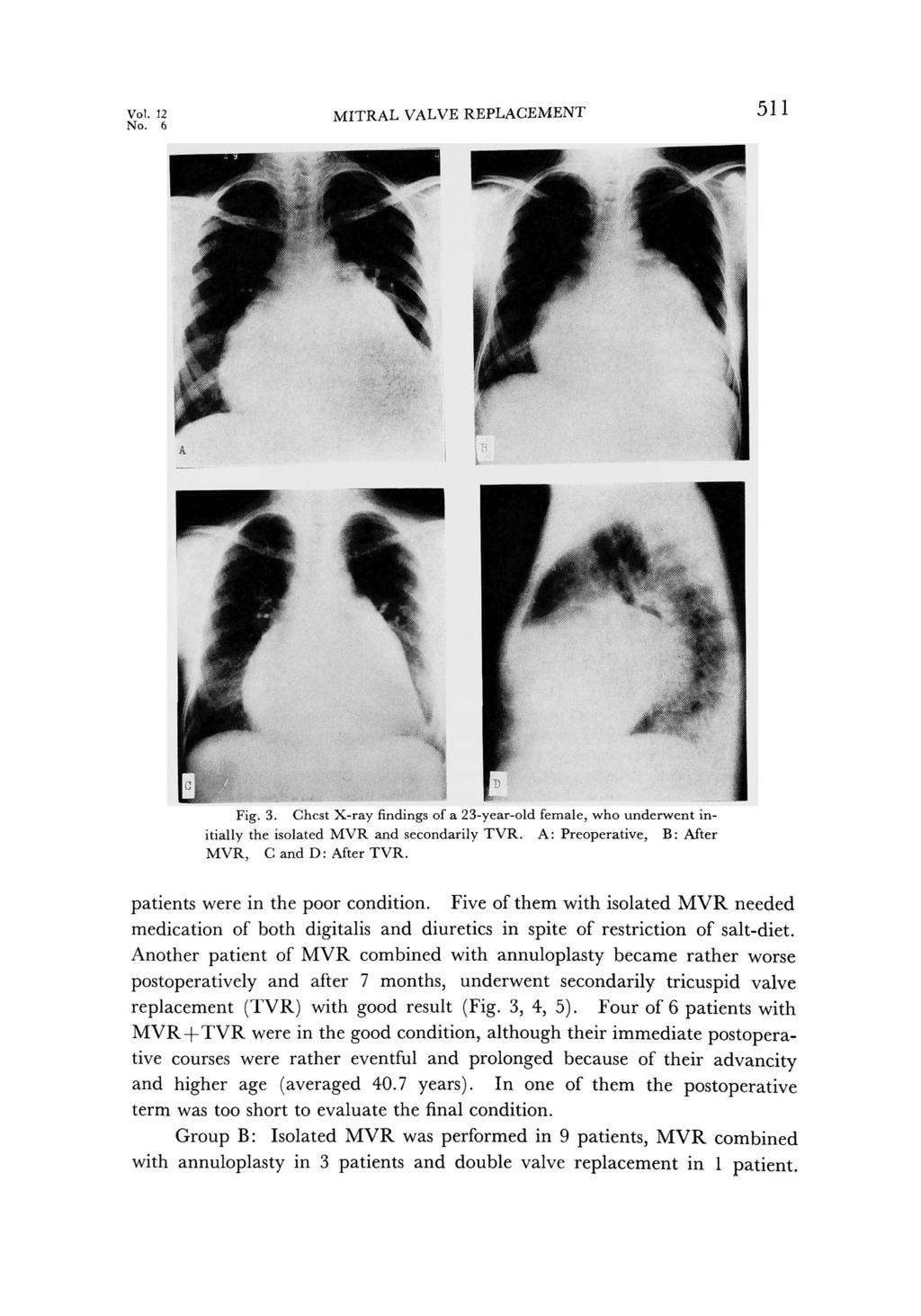 Vol.12 No.6 MITRAL VALVE REPLACEMENT 511 Fig.3. Chest X-ray findings of a 23-year-old female, who underwent initially the isolated MVR and secondarily TVR.