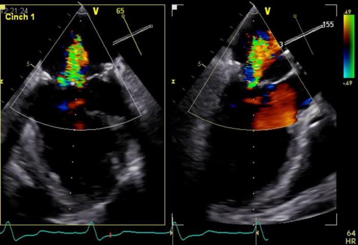 Cardioband Mitral