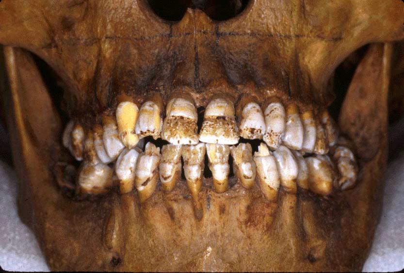 33 Defective teeth -