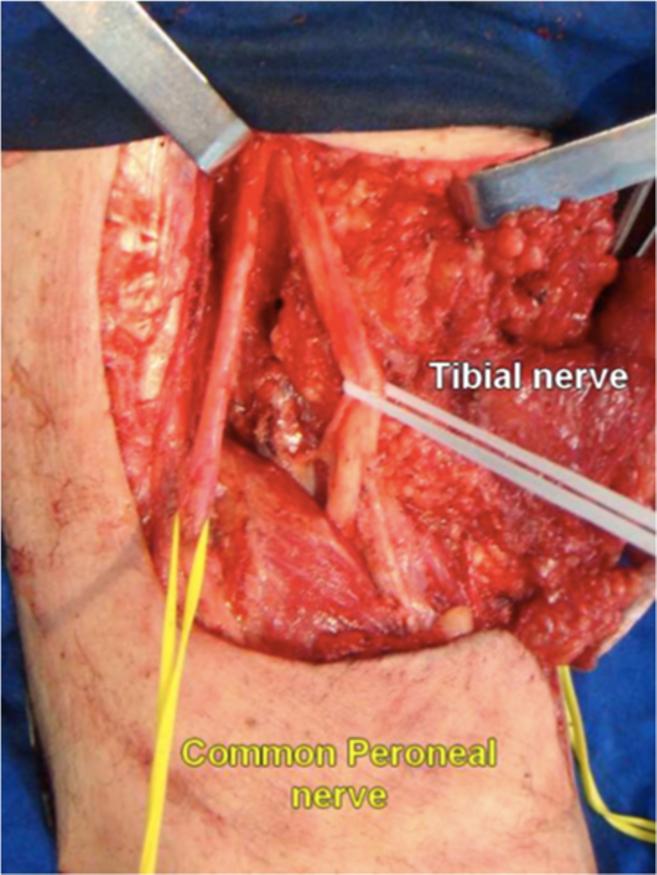 Teixeira et al. World Journal of Surgical Oncology 2014, 12:135 Figure 2 Bifurcation of sciatic nerve into common peroneal nerve and tibial nerve. vessels are now approached.