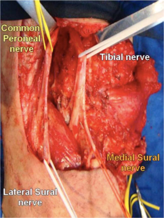 The descendent dissection continues and the small saphenous vein is ligated close to its insertion in the popliteal vein (Figure 5).