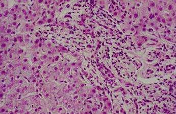 Progressive fibrosis in autoimmune biliary disease Progressive periportal fibrosis is associated with and may be