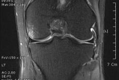 Normal ligament on MRI Uniform or gradual