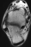 MRI of a healing injury: 1.