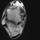 avulsion can be missed on MRI.