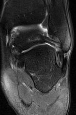 on MRI Ankle Lateral