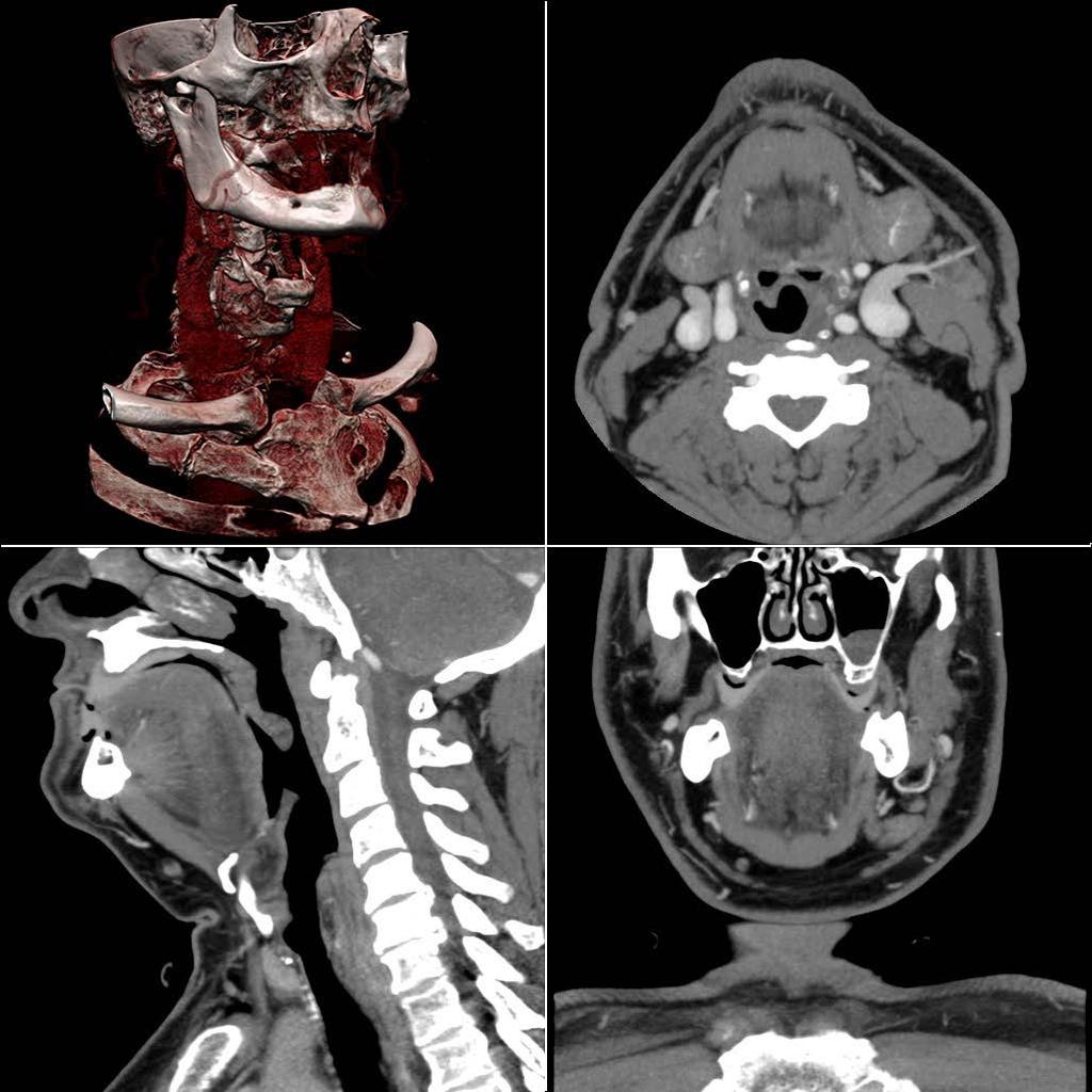 3D CT (3-Dimenstional Modeling/Rendering) Examples of multi-plane CT reconstructions of the lower skull and cervical spine.