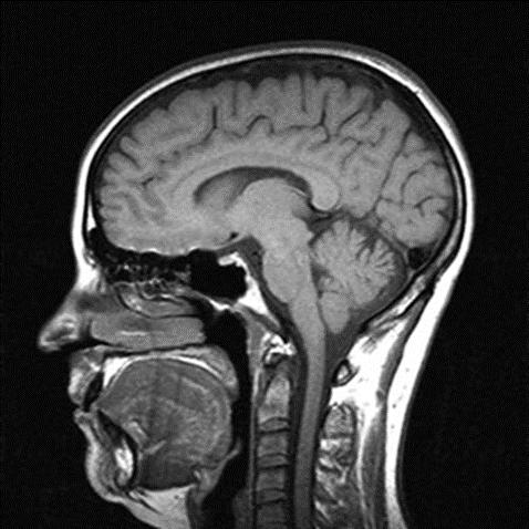 Sagittal Head CT