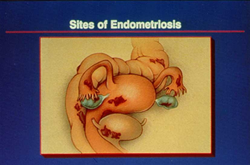 Sites of Endometriosis J