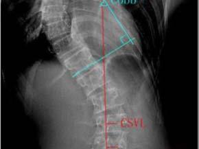 Observation Index All AIS patients underwent the full-length spinal anteroposterior-lateral and left-right Bending X-ray on an erect position before operation, and were asked to return to the