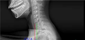 on bending X-ray of thoracic scoliosis)/cobb s angle on the anteroposterior X-ray of thoracic scoliosis before operation.
