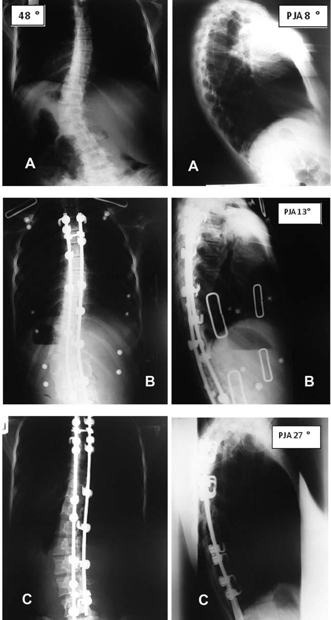 Proximal junctional kyphosis in adolescent Figure 1. A 17-year-old woman(lenke type 5CN) was fused with posterior segmental spinal hook instrumentation(t4- L4). A,The major coronal cobb angle was 48.