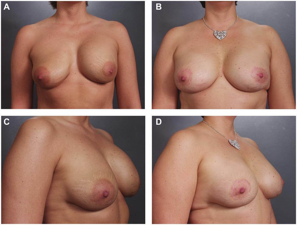 240 Aesthetic Surgery Journal 33(2) Figure 3. (A, C) This 38-year-old woman had undergone breast augmentation with subglandular saline implants (425 cc) 13 years prior to presentation.