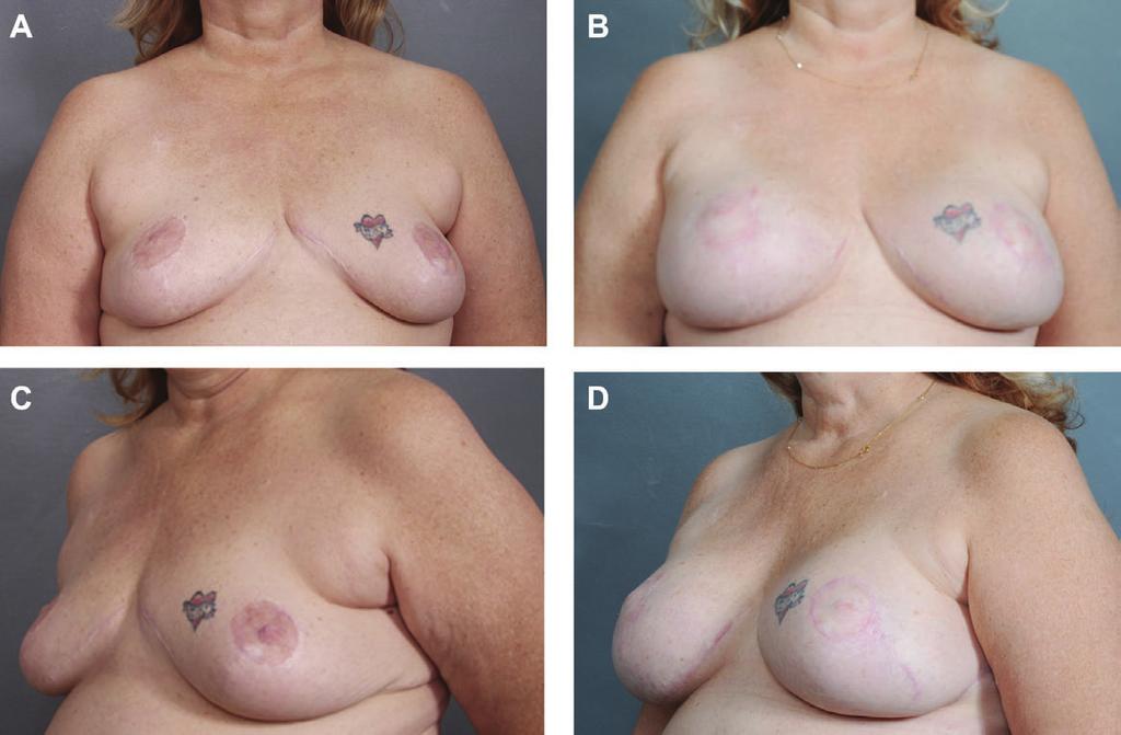 Grewal and Fisher 241 Figure 4. (A, C) This 46-year-old woman had undergone inverted-t pattern breast reduction 6 years prior to presentation.