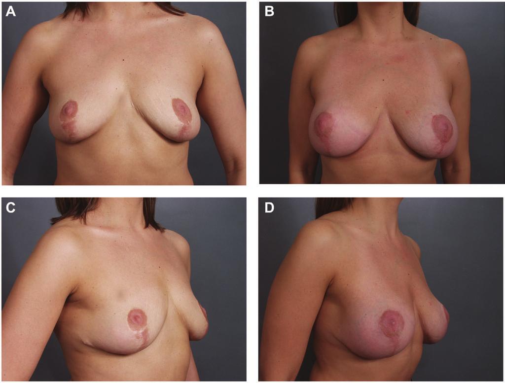 242 Aesthetic Surgery Journal 33(2) Figure 6. (A, C) This 44 year-old woman had undergone an inferior pedicle Wise-pattern breast reduction 3 years prior to presentation.