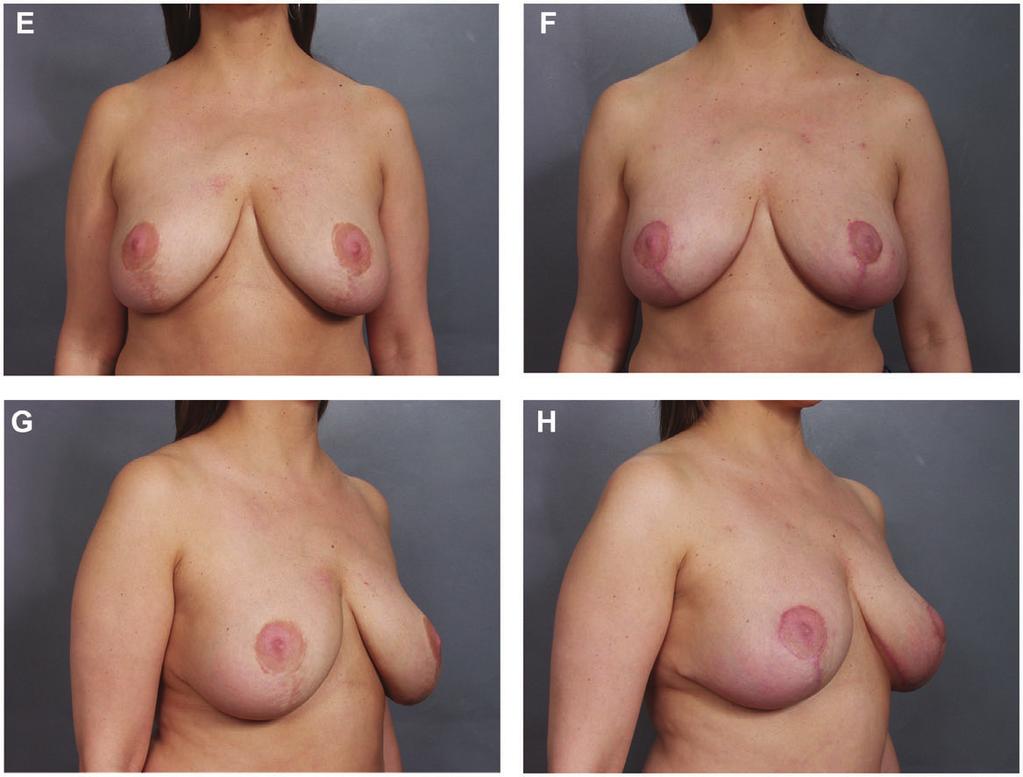 Grewal and Fisher 243 Figure 6. (continued) (A, C) This 44 year-old woman had undergone an inferior pedicle Wise-pattern breast reduction 3 years prior to presentation.