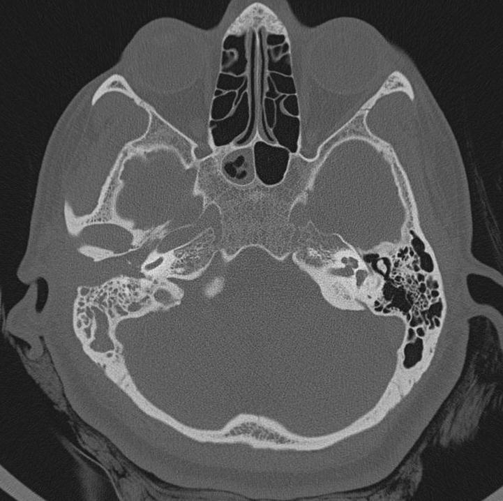 Of the six cases with anomalies, most commonly observed [3(50%)] anomaly was external auditory canal (EAC) atresia with