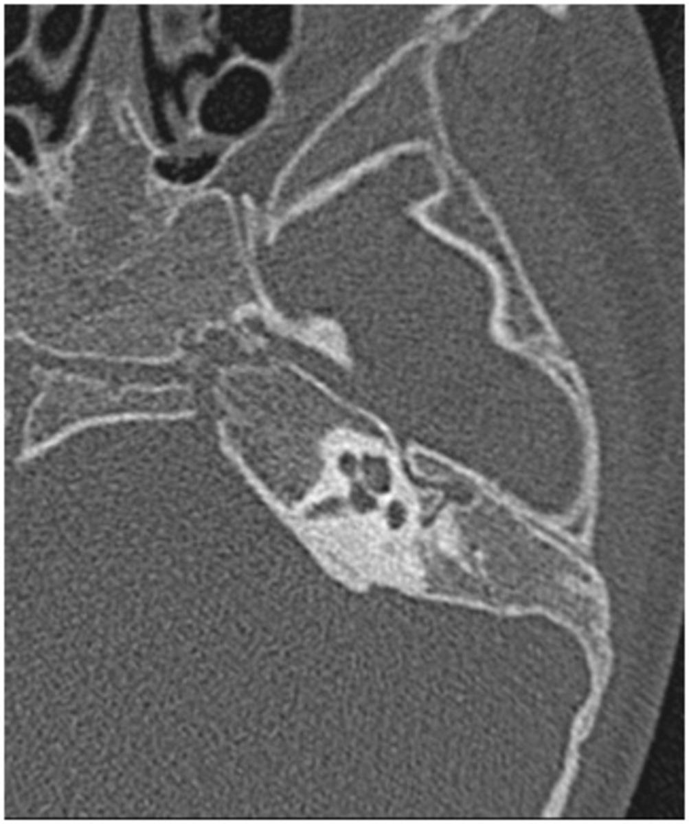 Fig. 4: Image 4: Aplasia of middle and external left ear.