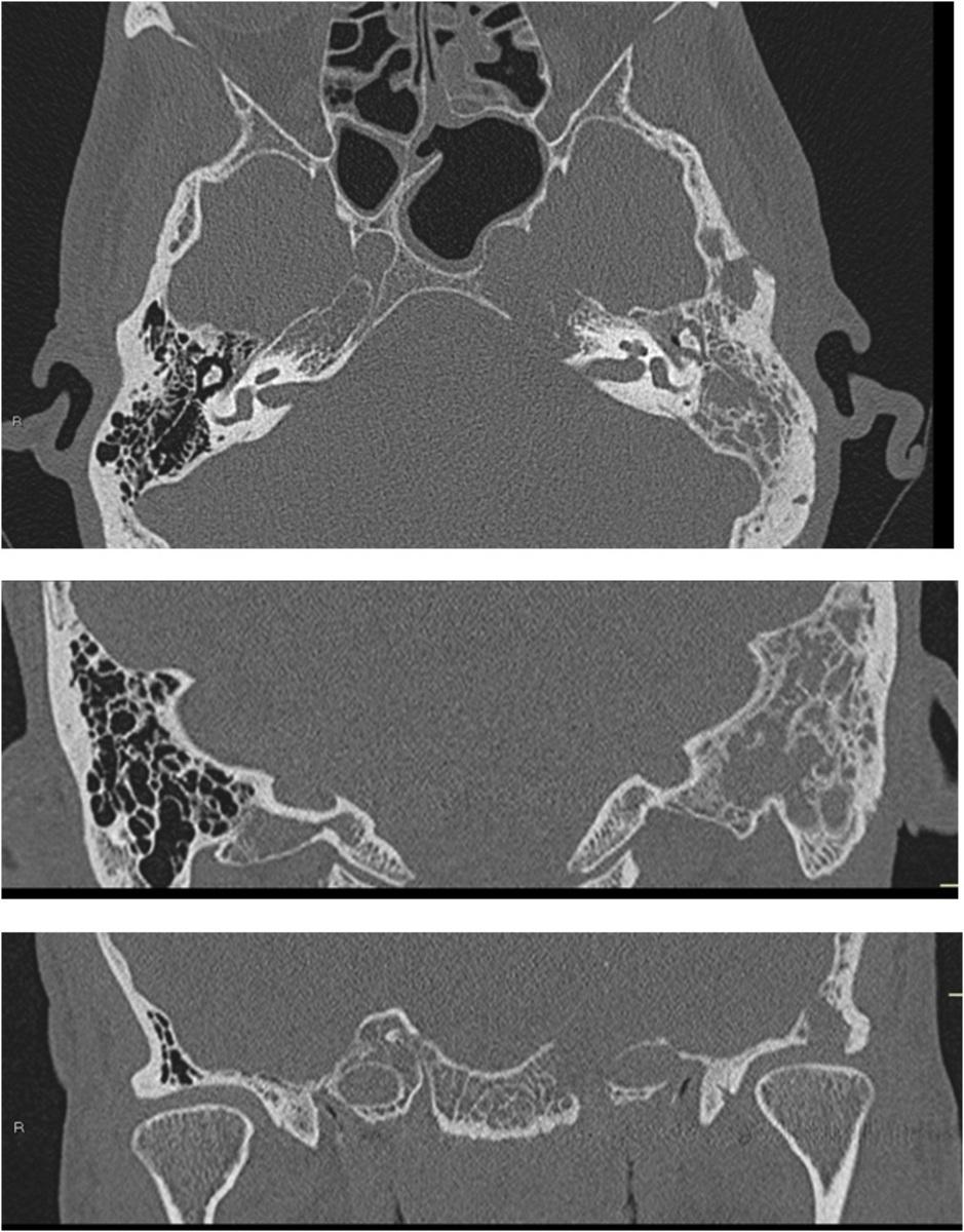 Fig. 5: CT axial and coronal images. ACUTE MASTOIDITIS AND PETROSITIS.