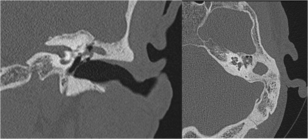 Fig. 7: CT axial and coronal images. CHOLESTEATOMA.