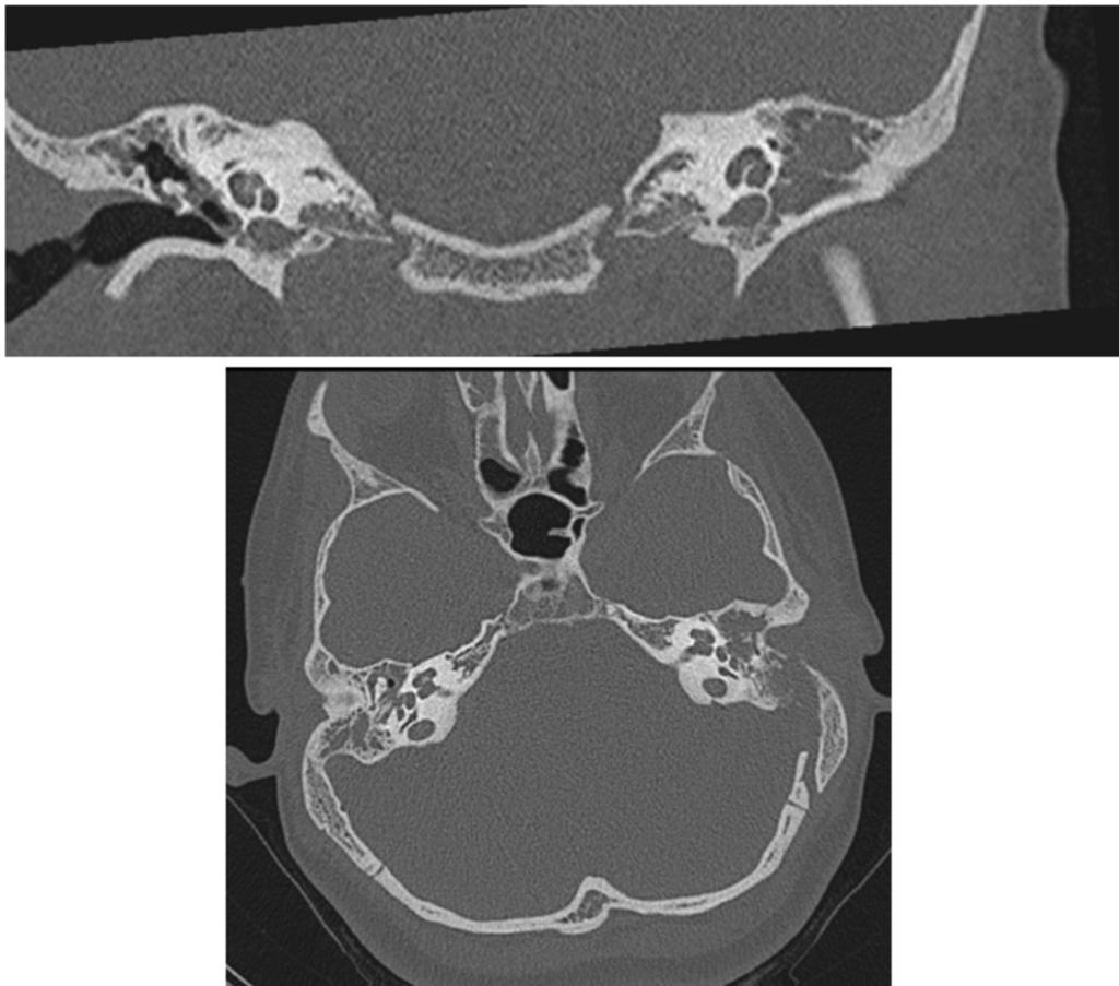 Fig. 9: CT coronal and axial image. 12-year-olded girl with history of acute otitis media and fever. Occupation of epitympanun, mastoid antrum and tympanic cavity by soft-tissue material.