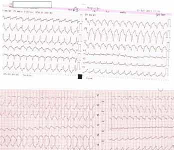 This myocardial damage is associated with ventricular tachycardia and increased risk of sudden cardiac death [1].