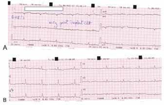 Pop-Mandru et al. 316 necessitated electrical shock for restoration of sinus rhythm (Figure 9 and Figure 10). No isoproterenol was administrated because VTs were induced during basal state.