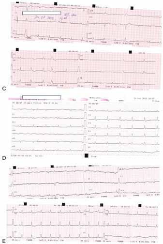 Figure 3: (A) Electrocardiography during admission to our hospital showing sinus rhythm, right-axis deviation, low voltage of the extremities, (B) incomplete right bundle branch block, T-wave