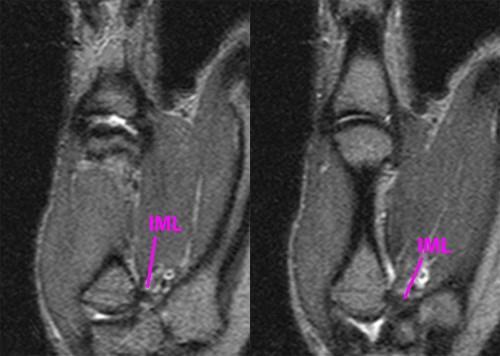 volar-ulnar tubercle of MC1 base Bested evaluated on sagittal images Resists