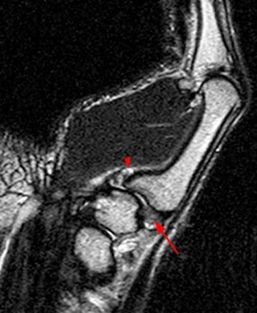 AOL degeneration is a primary factor in development and progression of thumb CMC osteoarthrosis.