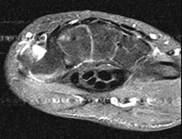 EPL EPB APL Full-thickness tear involving the dorsal deltoid ligament of the first