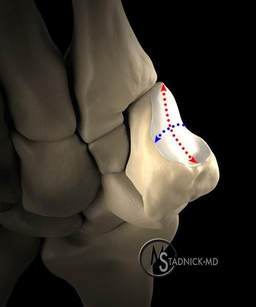Thumb Trapeziometacarpal Joint Shallow saddle joint with biconcave-convex shape