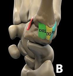Dorsal Deltoid Ligament Capsular ligaments Best evaluated on sagittal plane DRL Origin: dorsoradial tubercle of trapezium