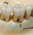with resorption and other bone defects on