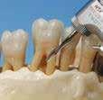 sub-gingival probing, scaling and root