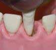 and extraction teeth Ref.
