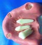 Extractable teeth with infection