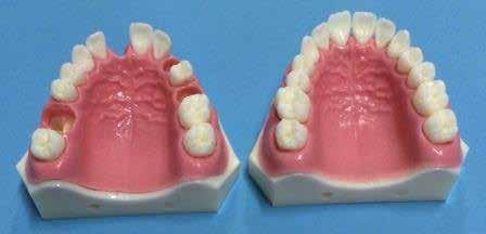 Exact socket in both central incisor