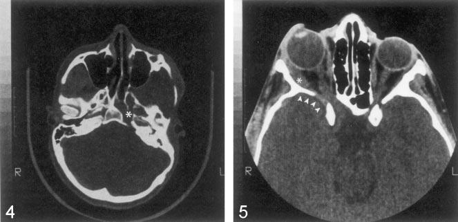 Posterior extension of the tumor into the cavernous sinus is marked by the large asterisk. Intraconal sensory nerves are contrast enhanced and thickened because of tumor infiltration.