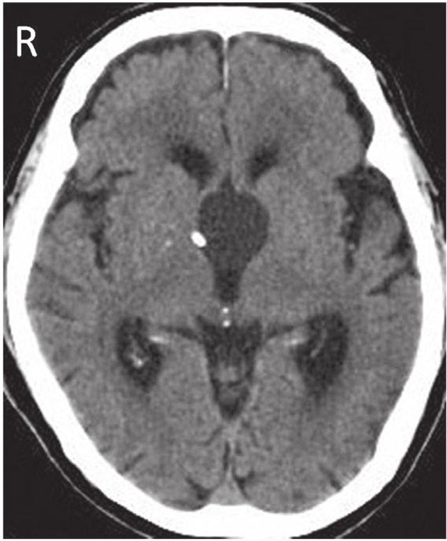Postoperative CT showed a collapsed cyst and a decrease in the size of the lateral ventricle ( Figure 6 ).