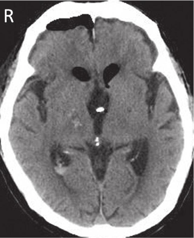 70 Sato et al., Neuroendoscopic palliative surgery in patients with craniopharyngioma also hydrocephalus. The operation time of the first NPS was 140 min. Her symptoms improved immediately.