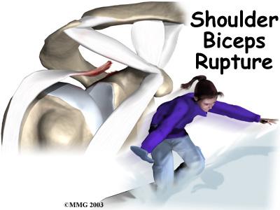 Introduction A biceps rupture involves a complete tear of the main tendon that attaches the top of the biceps muscle to the shoulder.