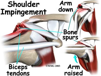 Often the biceps ruptures after a long history of shoulder pain from tendonitis (inflammation of the tendon) or problems with shoulder impingement.